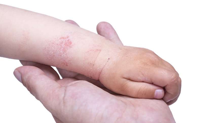 Аллергия у ребёнка – опасность повсюду!