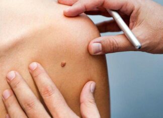 Живи без страху: як федеральний проект з ранньої діагностики меланоми рятує наші життя.