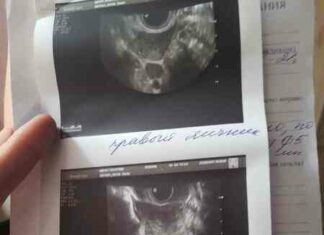 Міома або вагітність