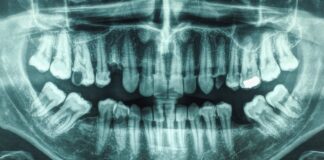 Malattie gengivali e carie legate ad un aumento del rischio di ictus: uno studio di 21 anni