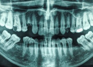 Захворювання ясен і карієс пов’язані з підвищеним ризиком інсульту: 21-річне дослідження